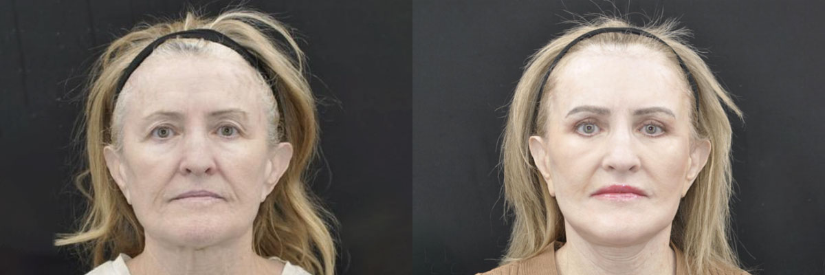Facelift Before & After Gallery - Patient 259851 - Image 3