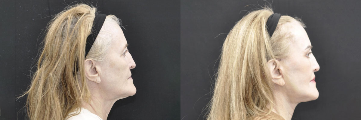 Facelift Before & After Gallery - Patient 259851 - Image 4