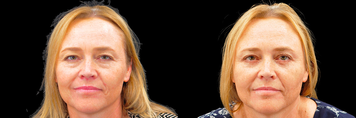 Blepharoplasty (Eyelid Surgery) Before & After Gallery - Patient 889458 - Image 1