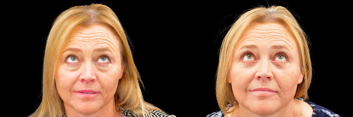 Blepharoplasty (Eyelid Surgery) Before & After Gallery - Patient 889458 - Image 2