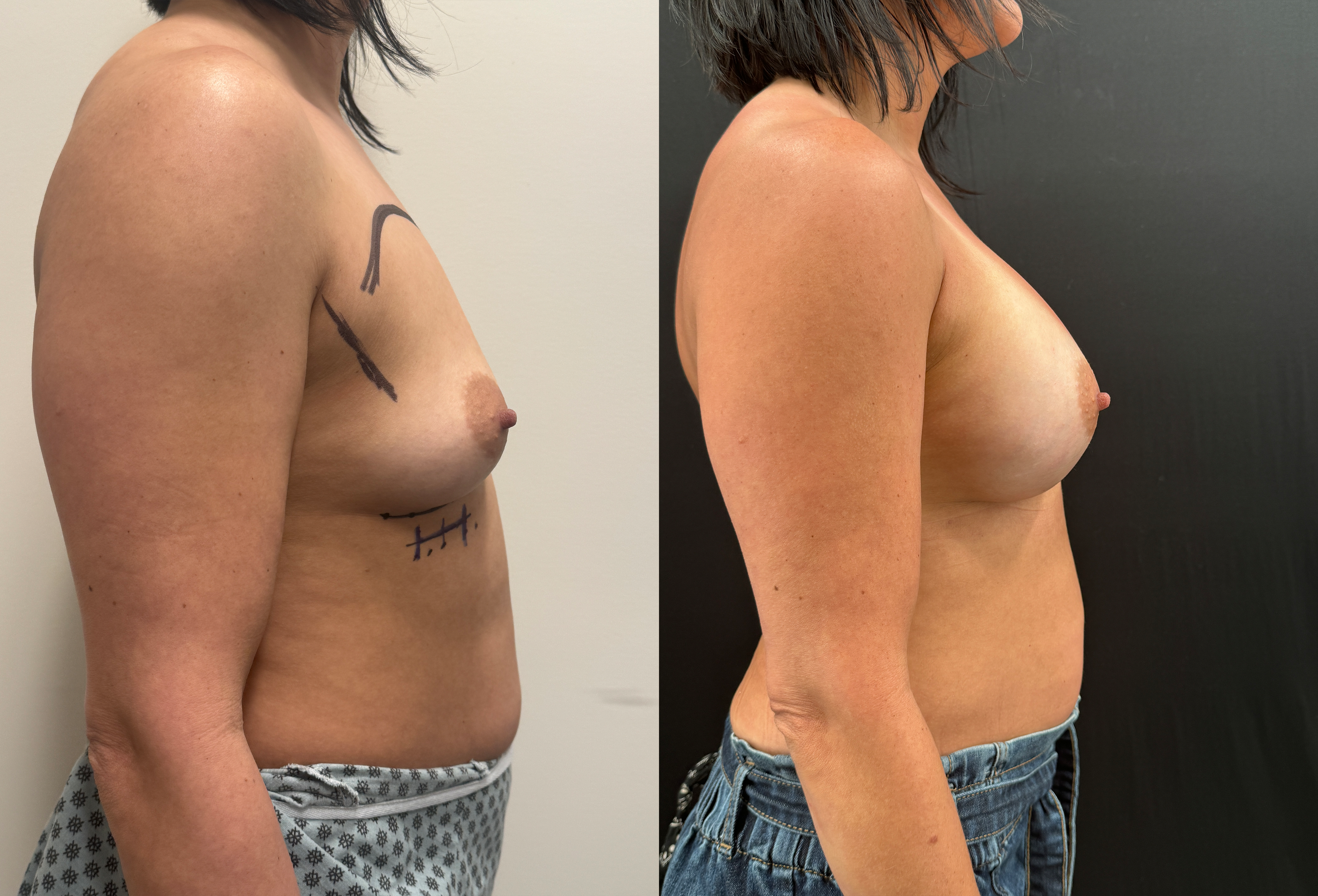Breast Augmentation Before & After Gallery - Patient 116215 - Image 3