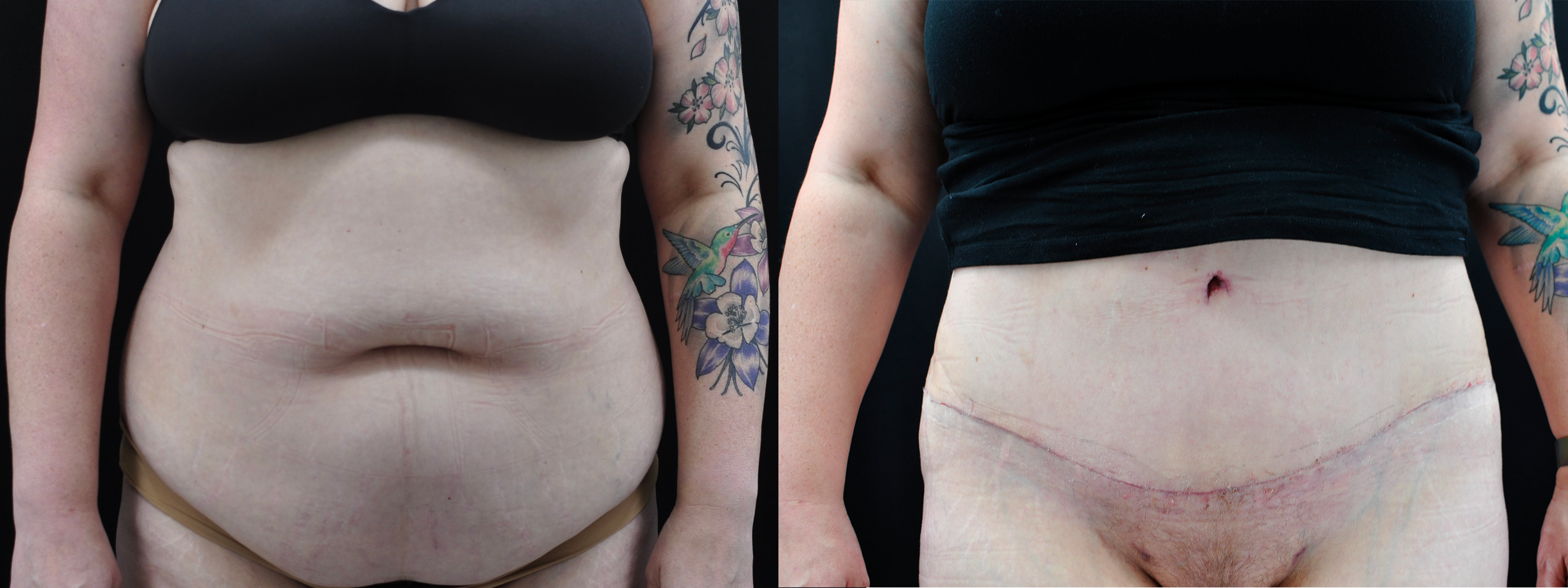 Abdominoplasty Before & After Gallery - Patient 323048 - Image 1