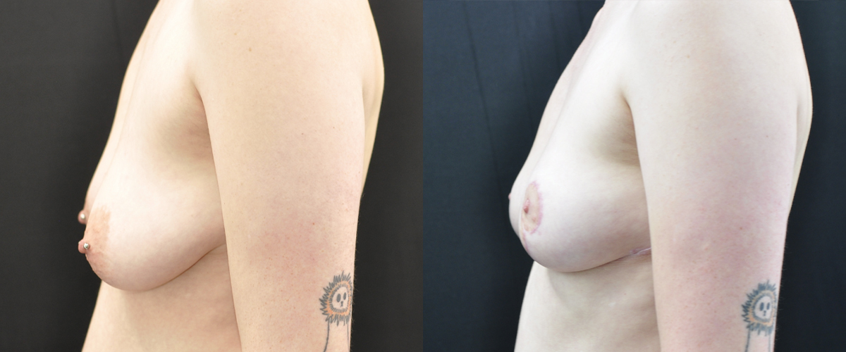 Breast Lift Before & After Gallery - Patient 449896 - Image 2