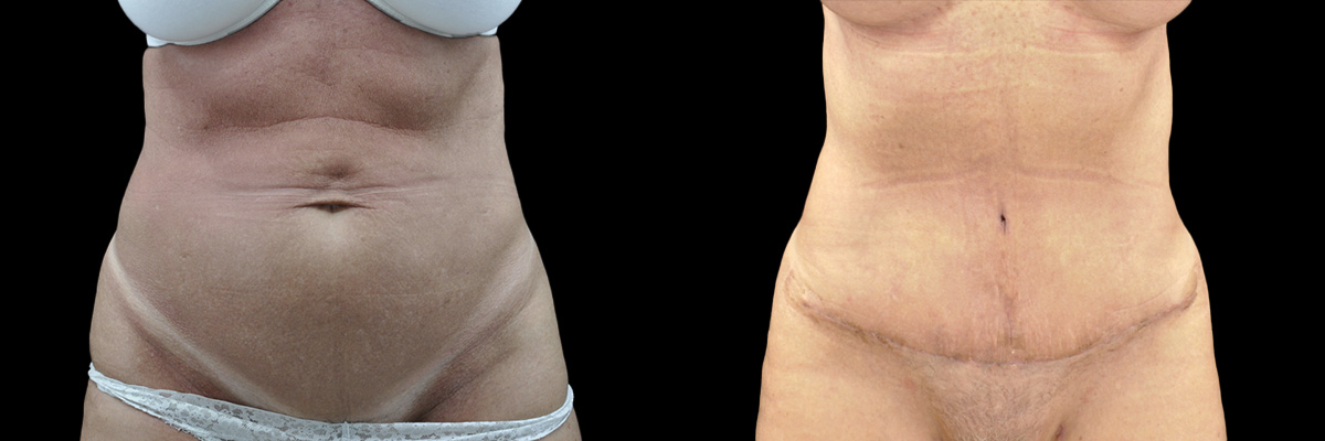 Abdominoplasty Before & After Gallery - Patient 270452 - Image 1
