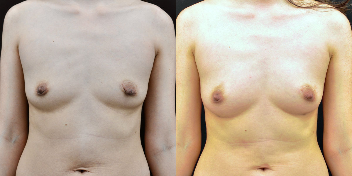 Breast Augmentation Before & After Gallery - Patient 280499 - Image 1