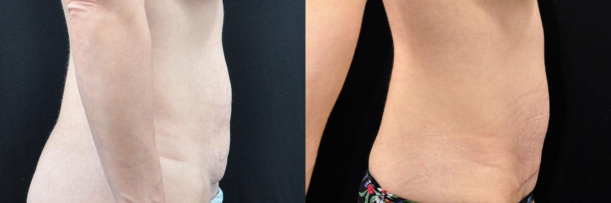 Liposuction Before & After Gallery - Patient 50245457 - Image 2
