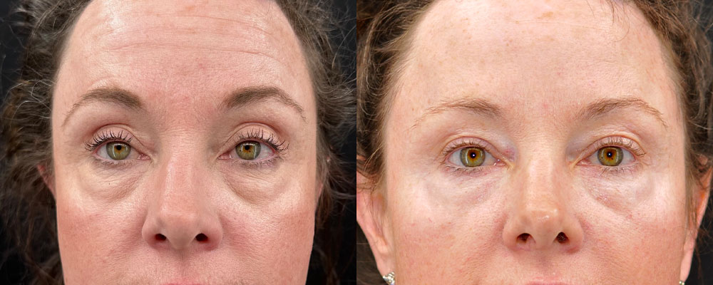 Blepharoplasty (Eyelid Surgery) Before & After Gallery - Patient 973421 - Image 1