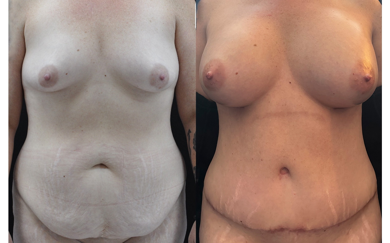 Mommy Makeover Before & After Gallery - Patient 403806 - Image 1