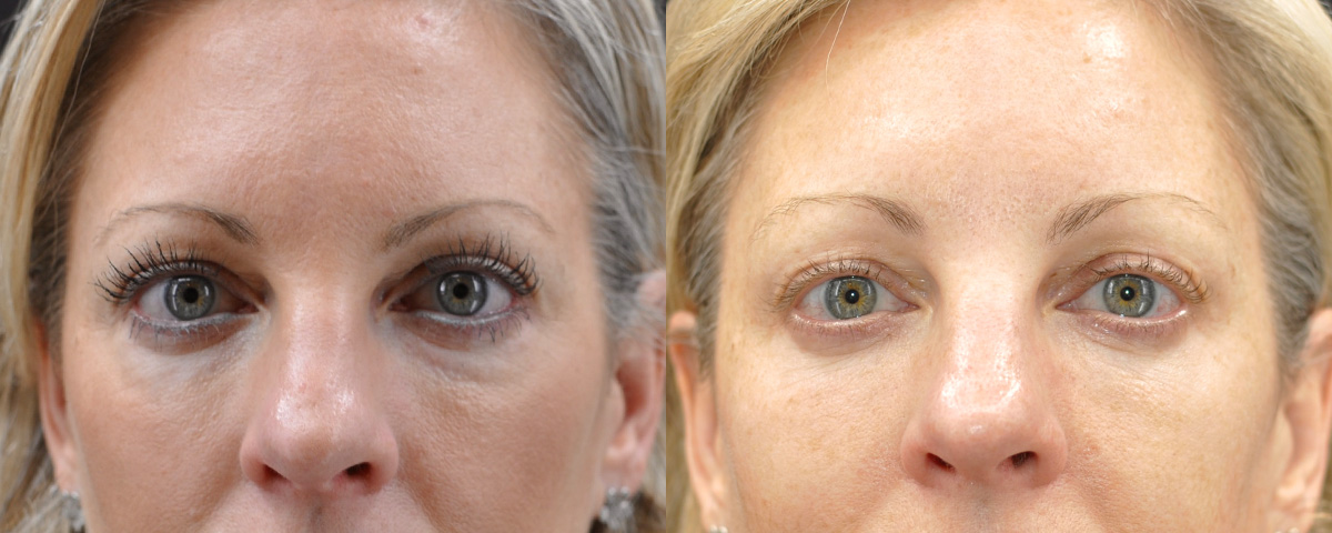 Blepharoplasty (Eyelid Surgery) Before & After Gallery - Patient 358001 - Image 1