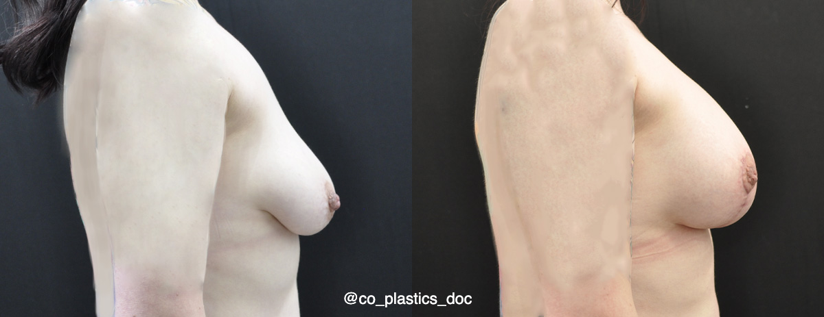 Breast Lift Before & After Gallery - Patient 296519 - Image 3