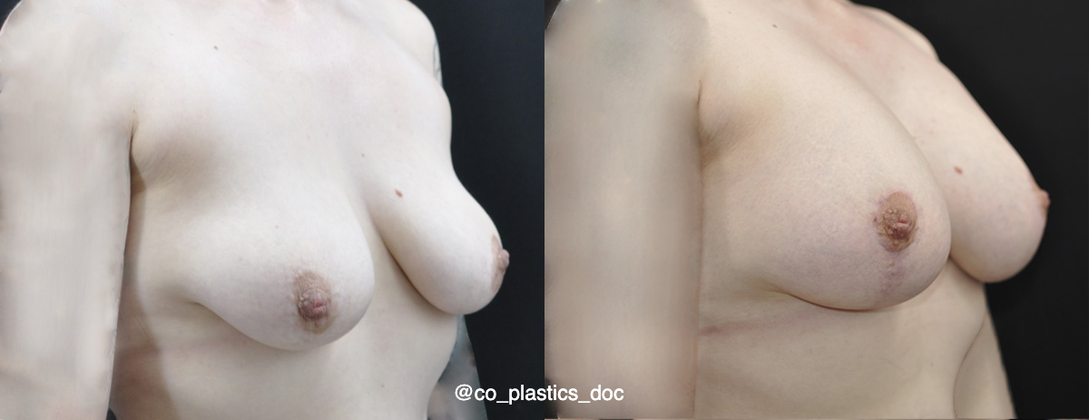Breast Lift Before & After Gallery - Patient 296519 - Image 2