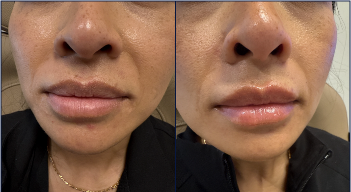 Lip Filler Before & After Gallery - Patient 185340 - Image 1