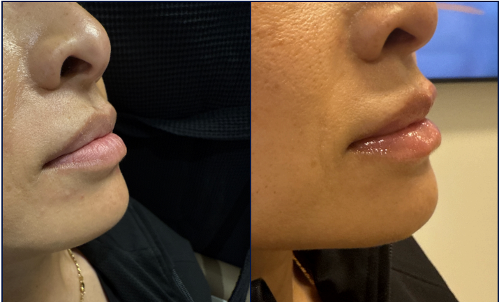 Lip Filler Before & After Gallery - Patient 185340 - Image 2