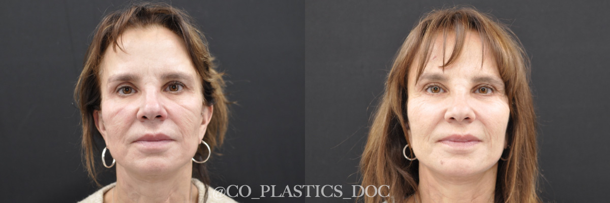 Facelift Before & After Gallery - Patient 115232 - Image 1