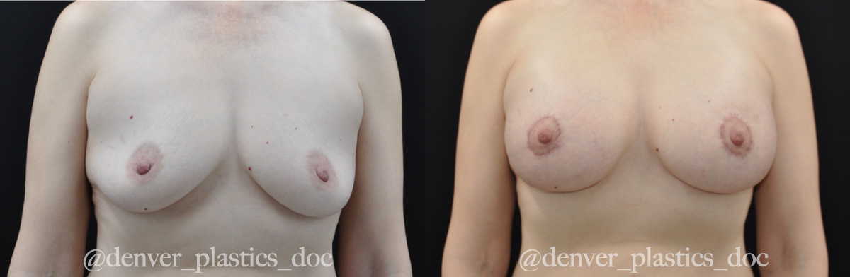 Breast Augmentation Before & After Gallery - Patient 362101 - Image 1