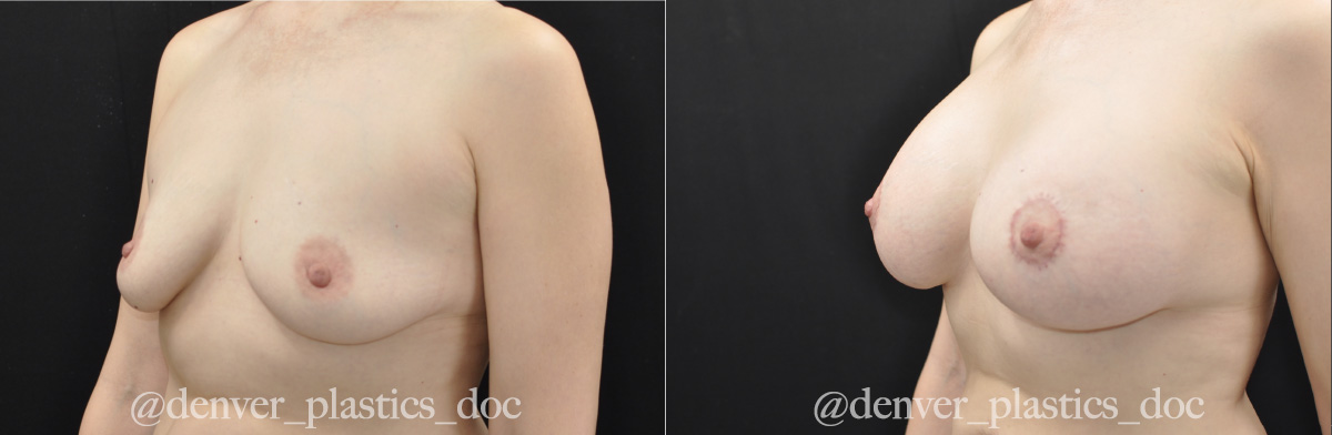 Breast Augmentation Before & After Gallery - Patient 362101 - Image 2