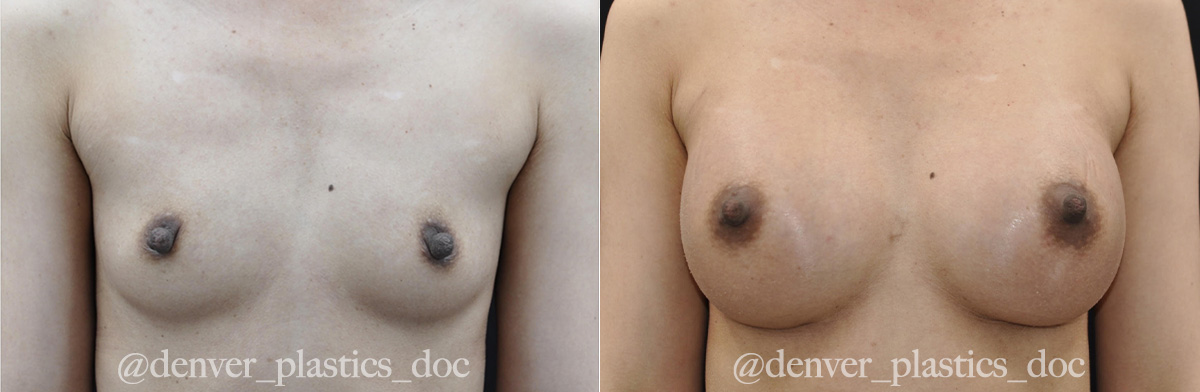 Breast Augmentation Before & After Gallery - Patient 289113 - Image 1