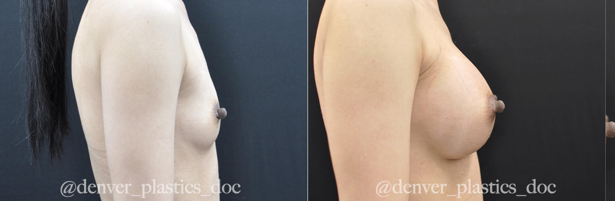Breast Augmentation Before & After Gallery - Patient 289113 - Image 2