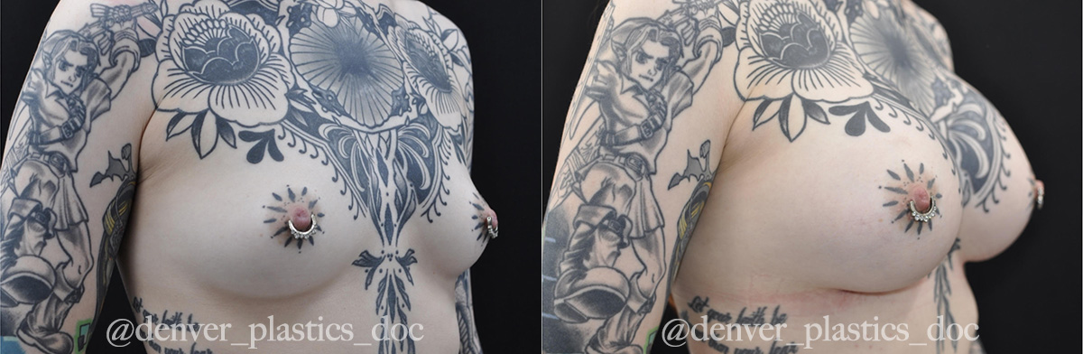 Breast Augmentation Before & After Gallery - Patient 825577 - Image 2