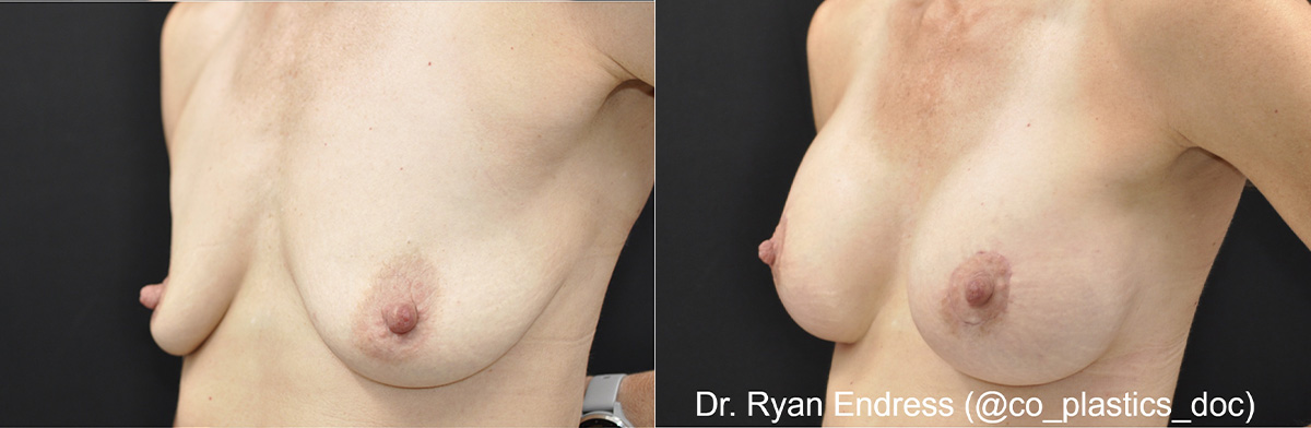 Breast Augmentation Before & After Gallery - Patient 282597 - Image 2