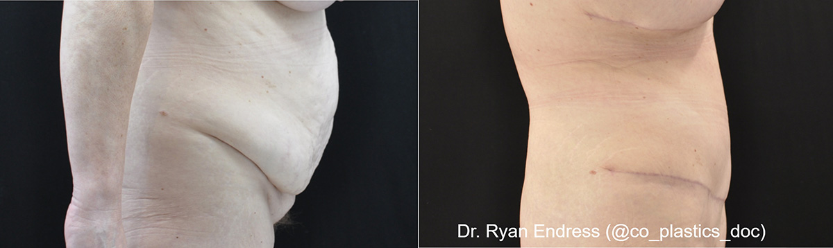 Abdominoplasty Before & After Gallery - Patient 162525 - Image 3