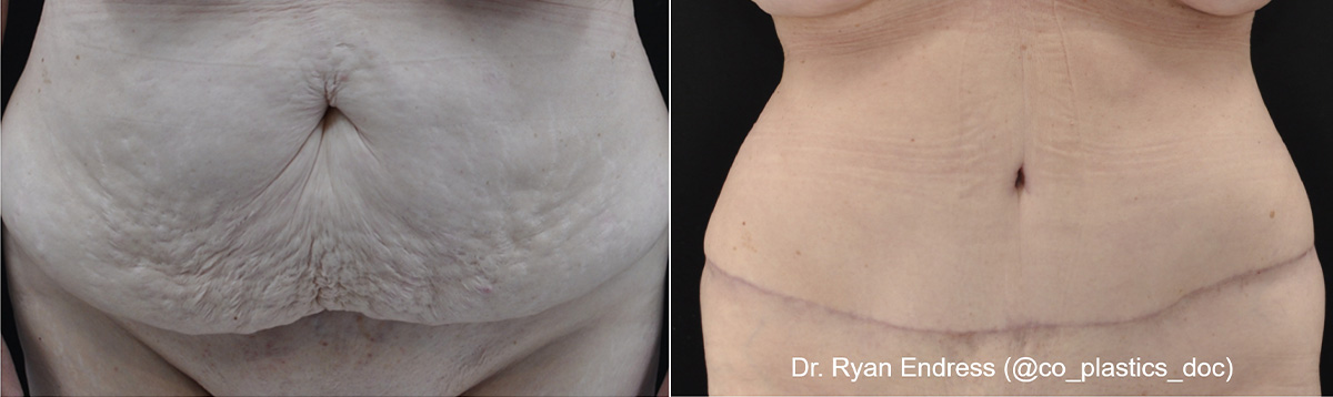 Abdominoplasty Before & After Gallery - Patient 162525 - Image 1