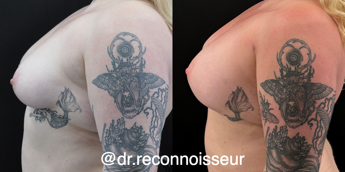 Breast Augmentation Before & After Gallery - Patient 142623 - Image 1