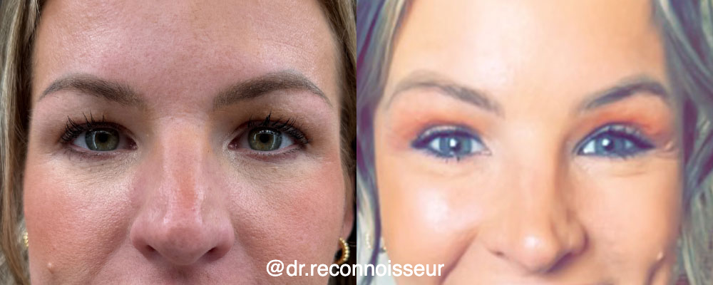 Blepharoplasty (Eyelid Surgery) Before & After Gallery - Patient 230239 - Image 1