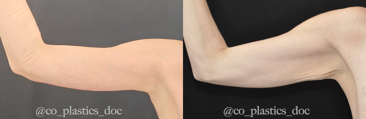 Brachioplasty Before & After Gallery - Patient 770606 - Image 3