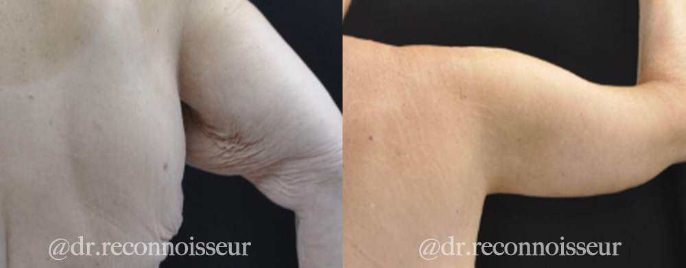 Brachioplasty Before & After Gallery - Patient 568318 - Image 2