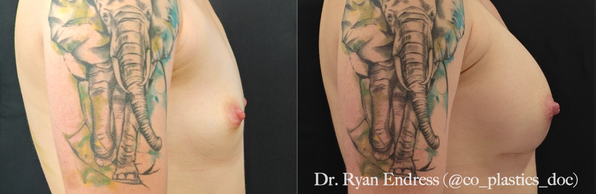 Breast Augmentation Before & After Gallery - Patient 201671 - Image 2