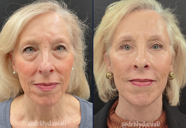 Facial Fat Transfer Before & After Gallery - Patient 849410 - Image 1