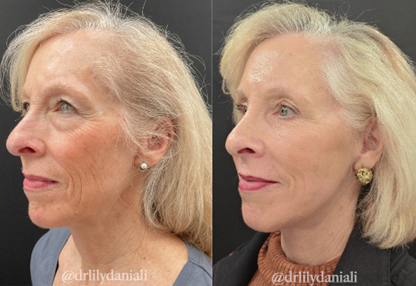 Facial Fat Transfer Before & After Gallery - Patient 849410 - Image 2