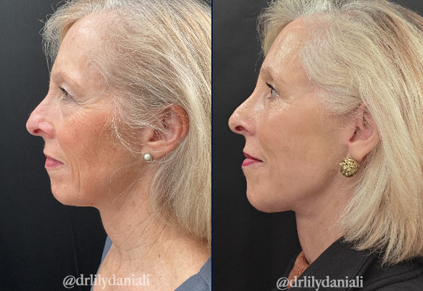 Facial Fat Transfer Before & After Gallery - Patient 849410 - Image 3