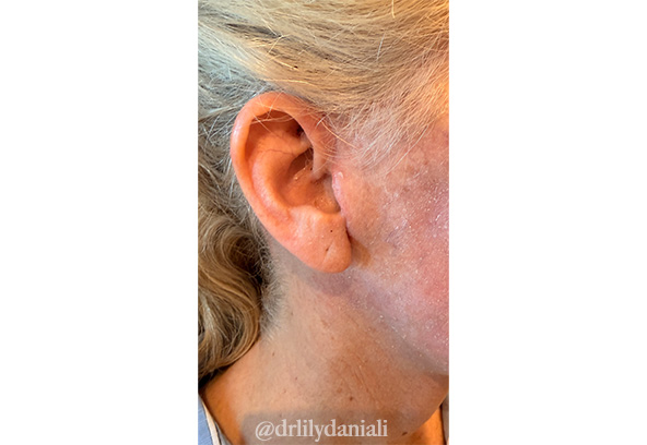 Facial Fat Transfer Before & After Gallery - Patient 849410 - Image 4