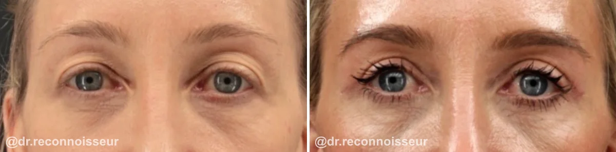 Blepharoplasty (Eyelid Surgery) Before & After Gallery - Patient 778833 - Image 1