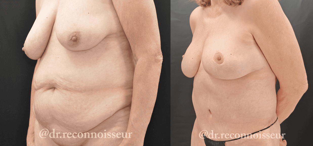 Mommy Makeover Before & After Gallery - Patient 403806 - Image 4