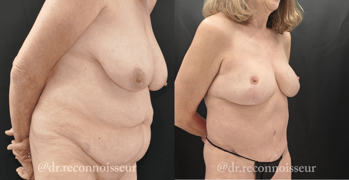 Mommy Makeover Before & After Gallery - Patient 403806 - Image 3