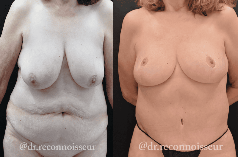 Mommy Makeover Before & After Gallery - Patient 403806 - Image 2